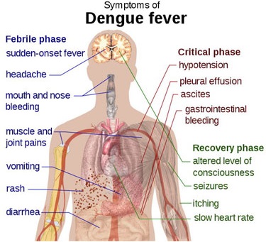 Symptoms of Dengue Fever